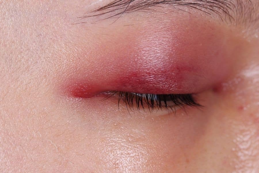 Things To Know Before You Get A Nose Job