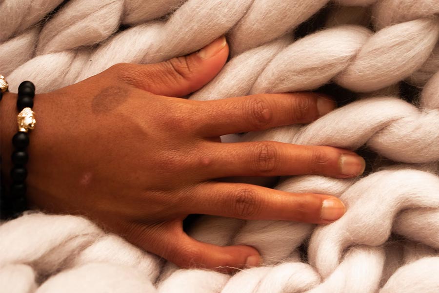 Can You Get Rid Of Birthmarks? Here’s All You Need To Know