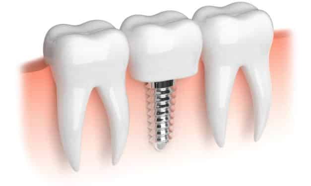 Dental Health – 4 Things To Consider Before Getting Dental Implants