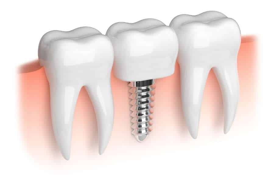 Dental Health – 4 Things To Consider Before Getting Dental Implants
