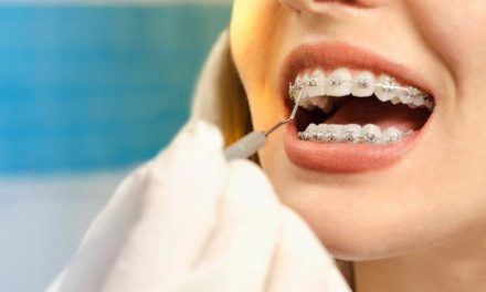 Can Adults Get Braces? We Explore This Thorny Topic