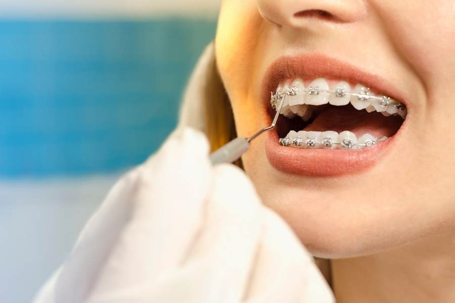 Can Adults Get Braces? We Explore This Thorny Topic